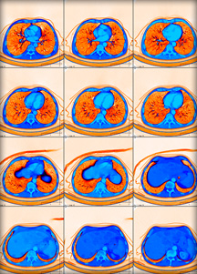 Лечение в Австрии: КТ легких