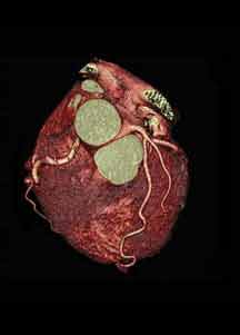 КТ сердца